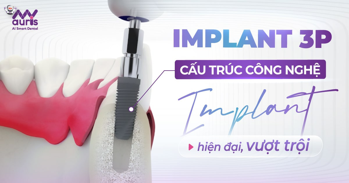 Implant 3p công nghệ implant hiện đại, vượt trội