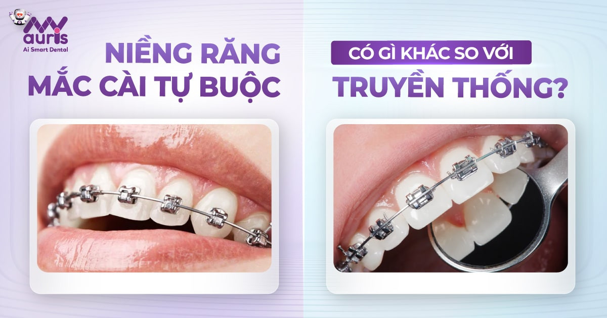 Niềng răng mắc cài tự buộc khác gì so với truyền thống (2)