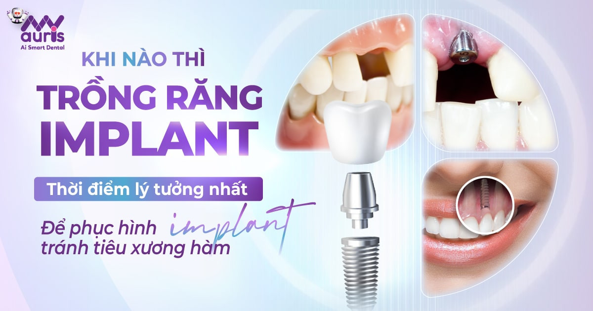 Thời điểm khi nào thì trồng răng implant ý tưởng nhất