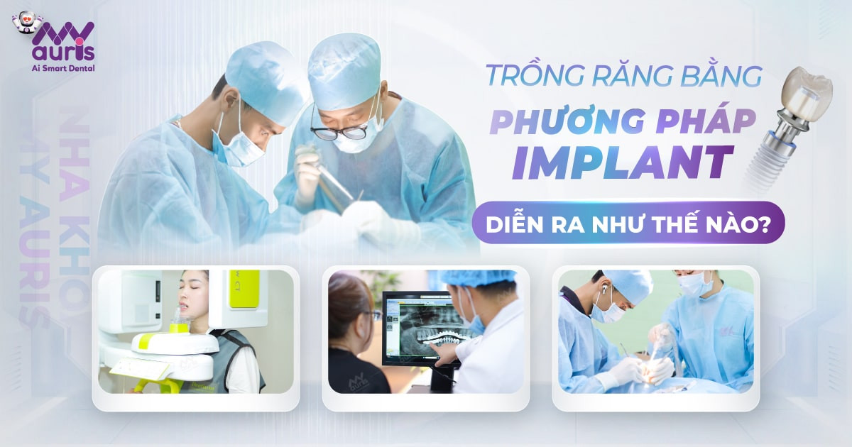 Trồng răng bằng phương pháp implant diễn ra như thế nào