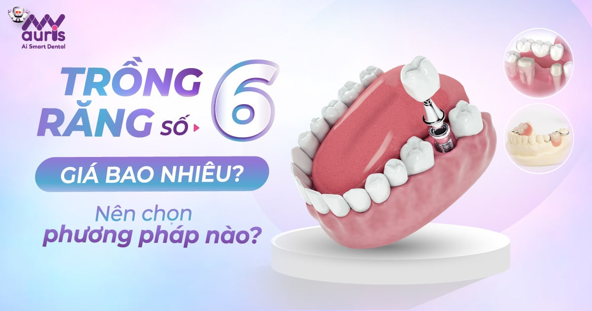 Trồng răng số 6 giá bao nhiêu - Nên chọn phương pháp nào