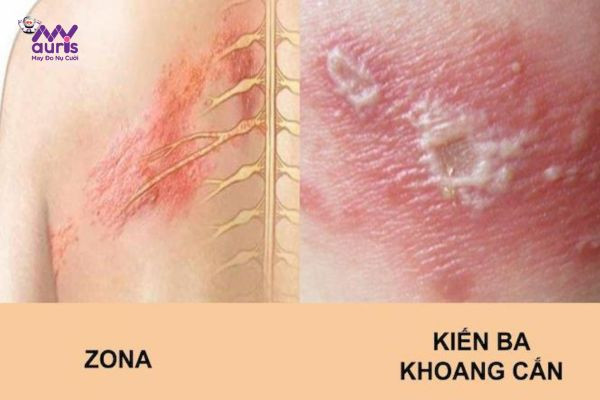 bị kiến ba khoang cắn kiêng ăn gì