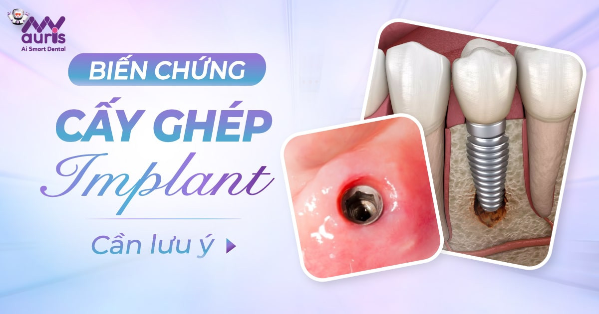 7 biến chứng cấy ghép Implant cần được lưu ý