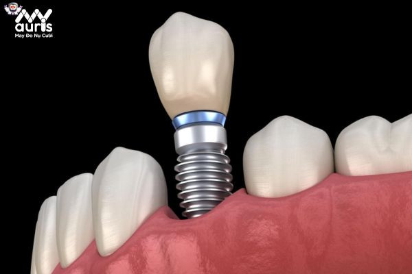 Đặc điểm chung của các loại trụ Implant trong nha khoa 