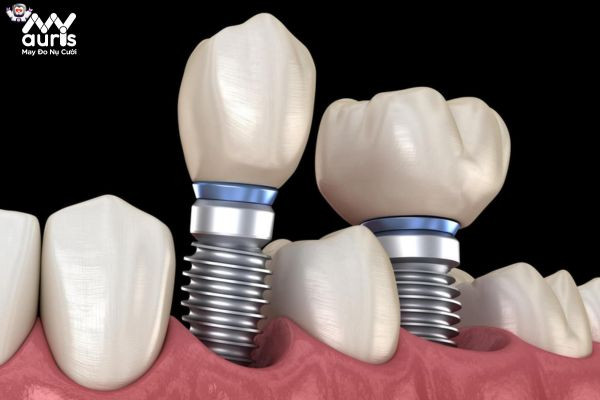 Sự khác nhau trong cấu tạo các trụ Implant 