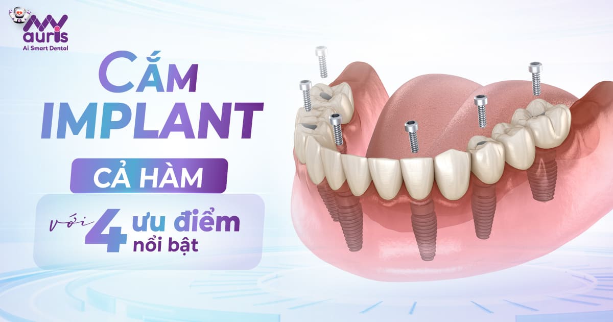 cắm implant cả hàm