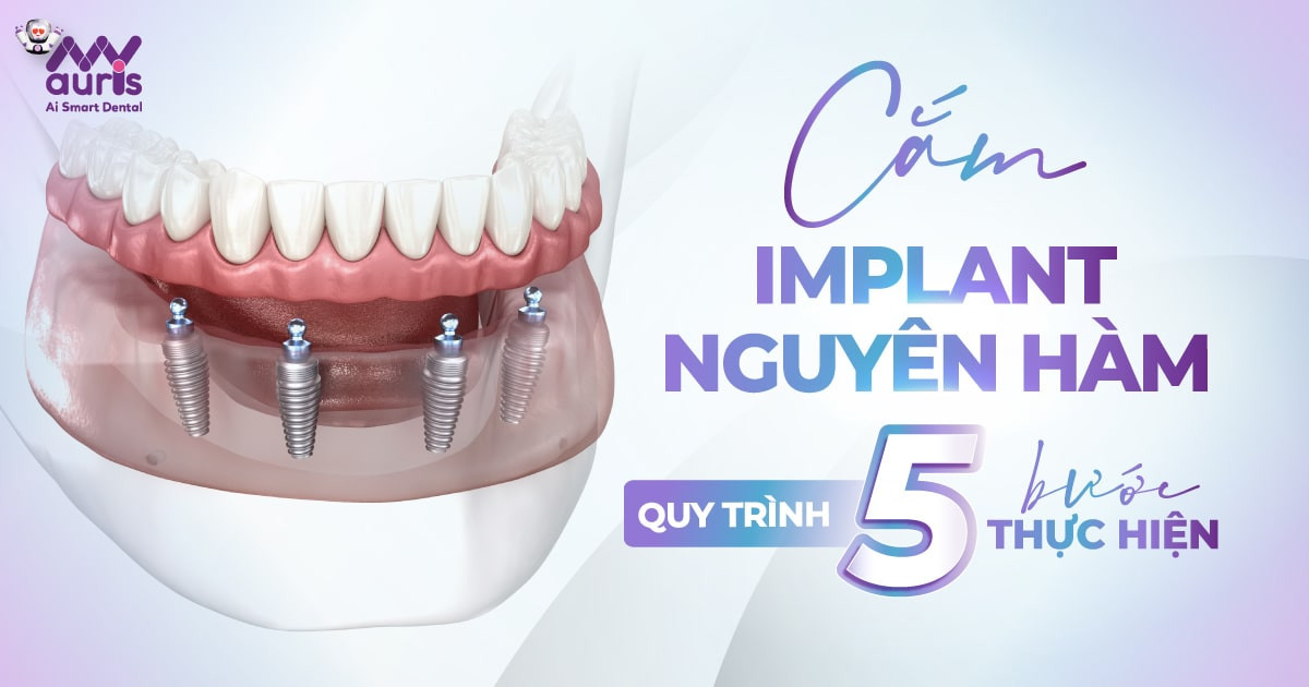 Cắm Implant nguyên hàm - Quy trình 5 bước thực hiện