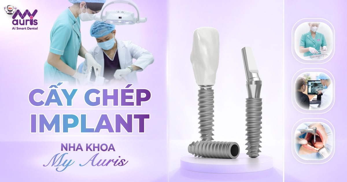 Cấy ghép Implant ở đâu tốt? 6 tiêu chí đánh giá