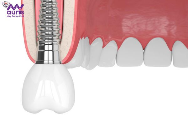 Giải đáp: Cấy ghép răng Implant giá bao nhiêu?