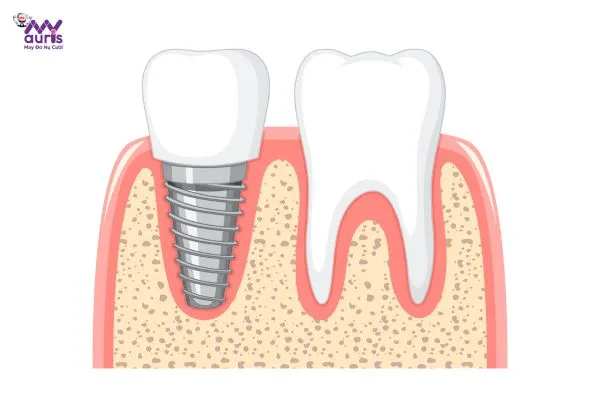 cấy răng implant có đau không 