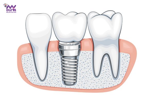 cấy răng implant có đau không 