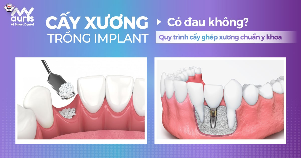 cay-xuong-trong-implant-co-dau-khong-quy-trinh-cu-the