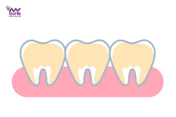 răng sứ cercon thường 