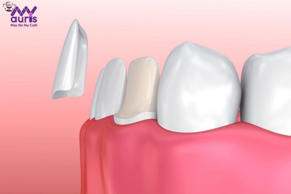 Dán mặt răng sứ Veneer là phương pháp gì?