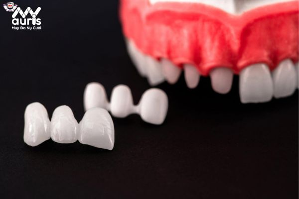 Bắc cầu răng sứ cải thiện sức khỏe răng miệng 