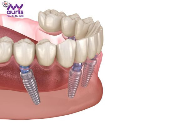 Quy trình gắn răng sứ lên Implant diễn ra như thế nào?