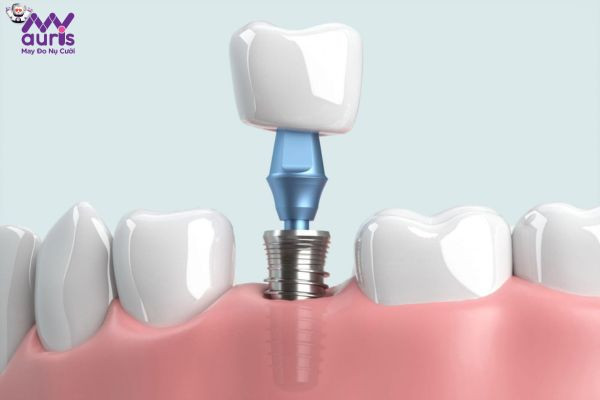 Giải đáp gắn răng Implant là kỹ thuật gì?