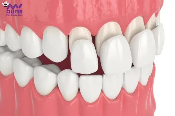 Gắn răng sứ Veneer là phương pháp gì?