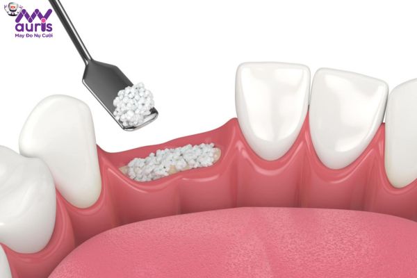 Vì sao phải cấy ghép xương khi trồng răng Implant?