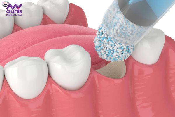 Ghép xương để cấy ghép Implant là phương pháp gì?