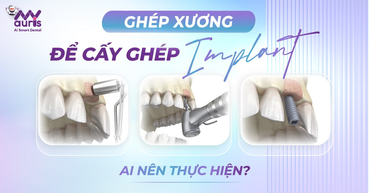 Ai nên và không nên ghép xương để cấy ghép Implant?