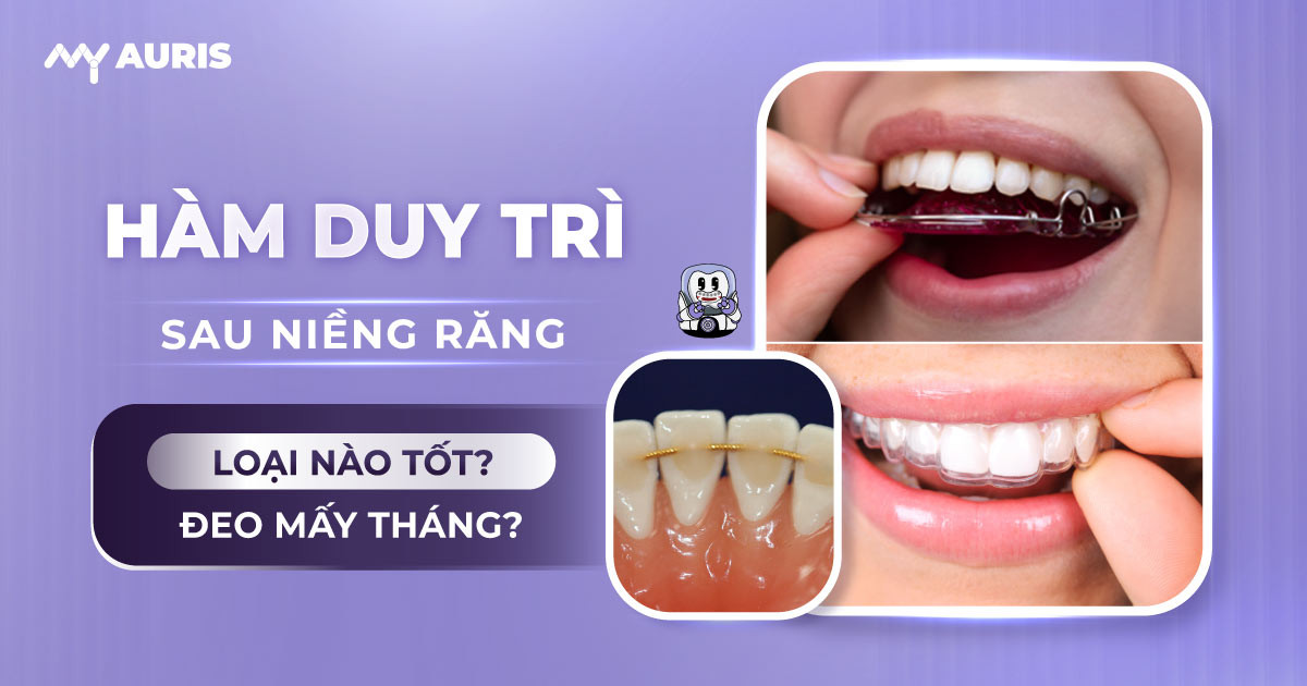 hàm duy trì sau khi niềng răng,hàm cố định sau khi niềng răng
