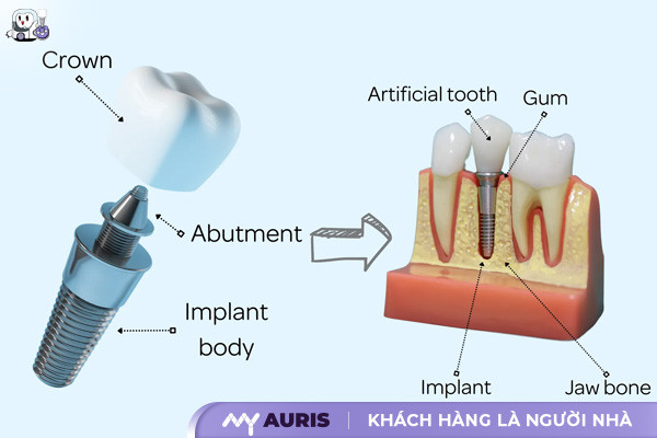 Implant Abutment