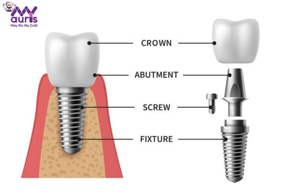 Implant Abutment là gì?