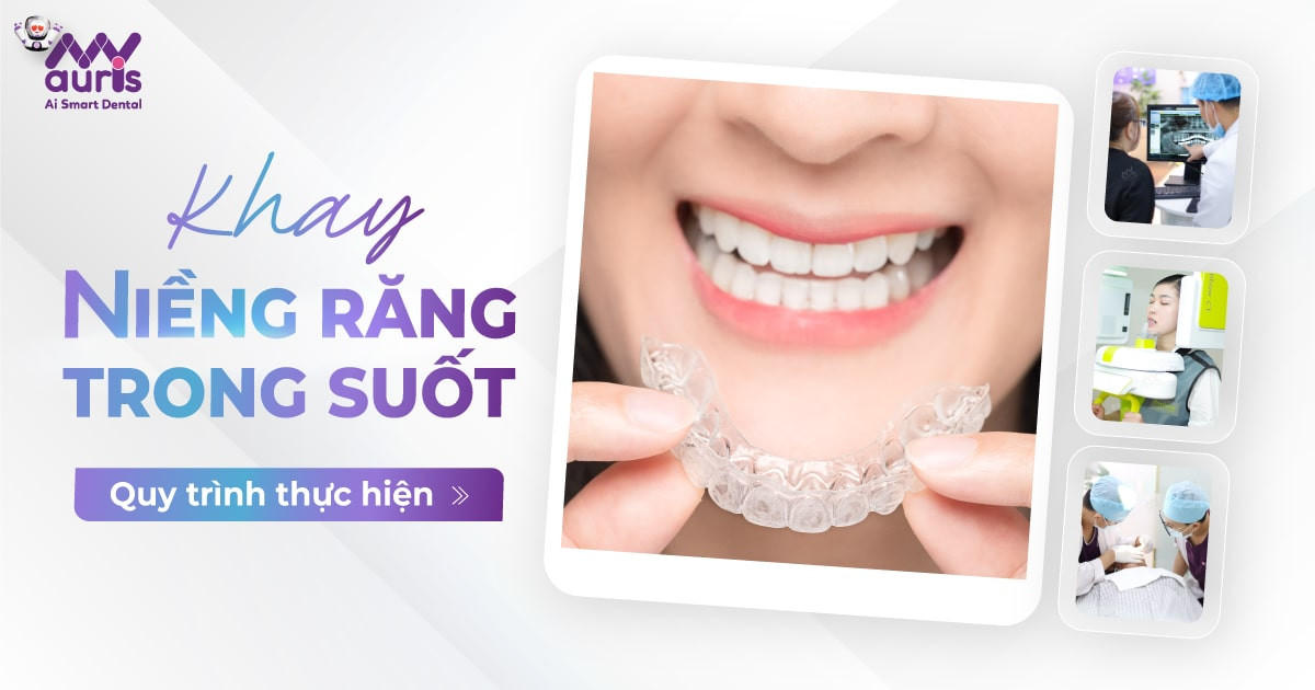 Khay niềng răng trong suốt (8 bước chỉnh nha an toàn)