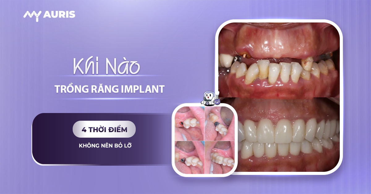 khi nào thì trồng răng implant