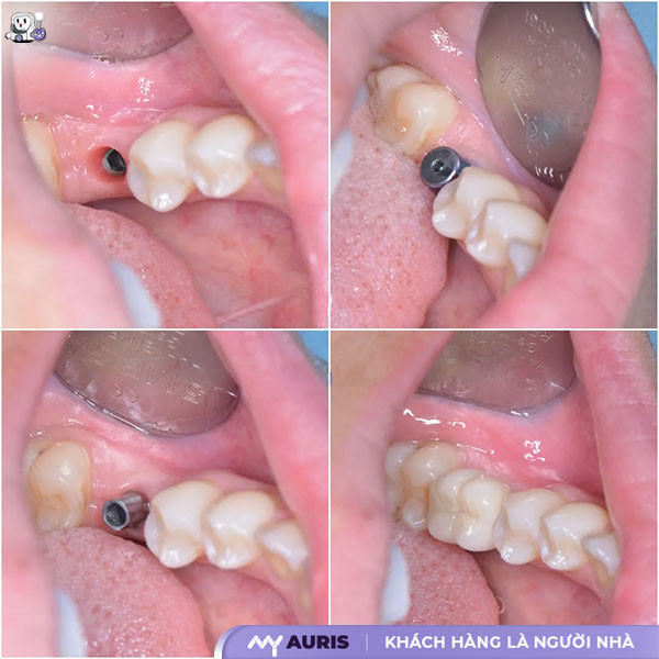 khi nào thì trồng răng implant