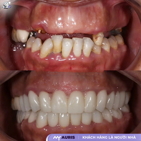 khi nào thì trồng răng implant