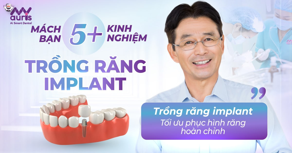 mach-ban-5-kinh-nghiem-trong-rang-implant