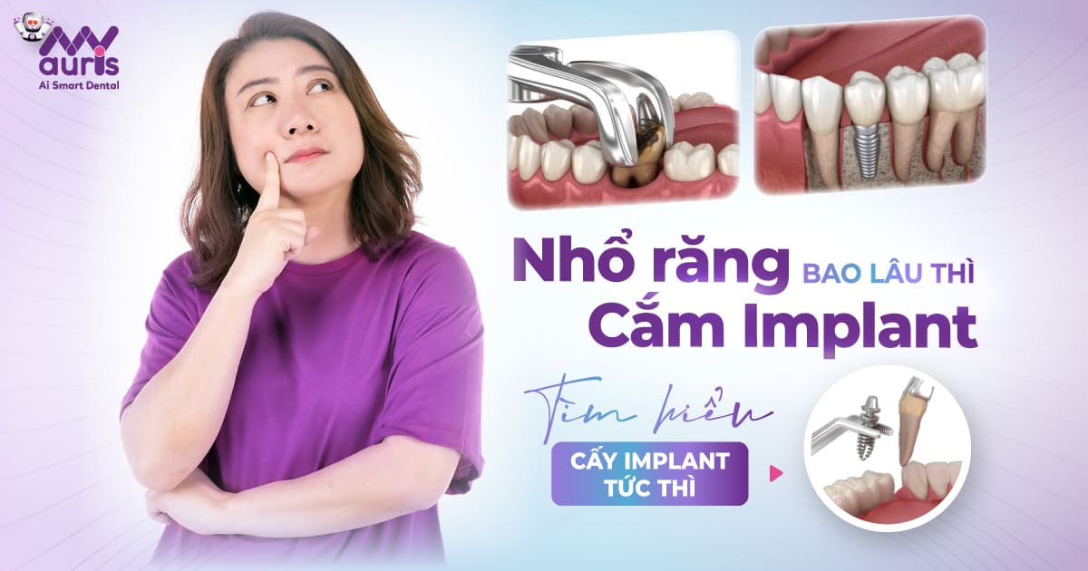 nhổ răng bao lâu thì cắm implant