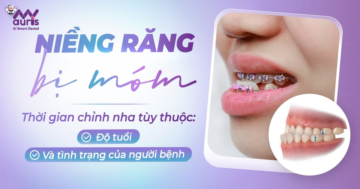 [Giải đáp] Niềng răng bị móm mất thời gian bao lâu?