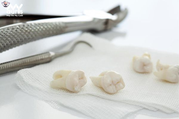 Nhổ răng tạo khoảng cách cho răng dịch chuyển là một trong những giai đoạn gây đau khi niềng 