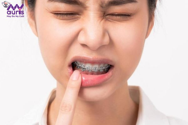 Bác sĩ chia sẻ: Niềng răng có đau không?