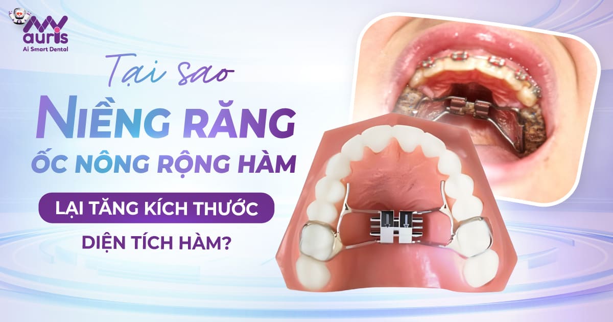 niềng răng ốc nông rộng