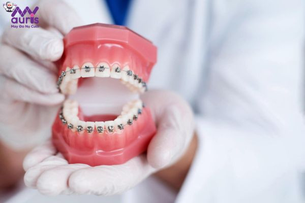 Các yếu tố gây ảnh hưởng đến chi phí niềng răng 
