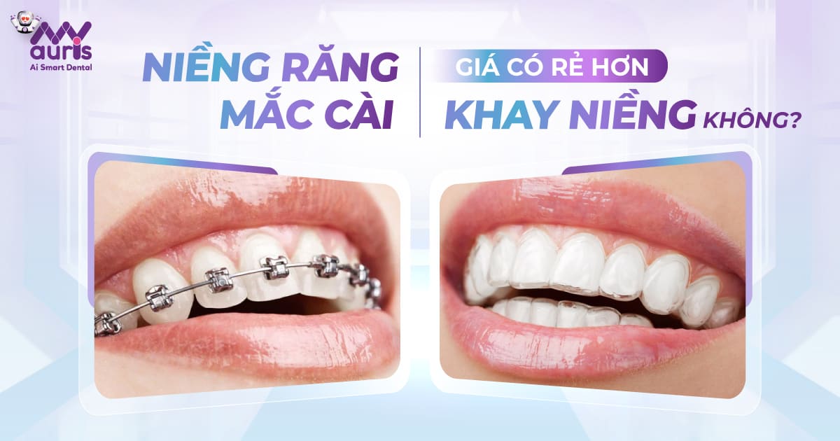 niềng răng mắc cài giá