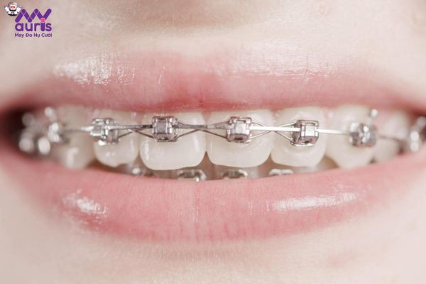 Có nên niềng răng với mắc cài kim loại tự khóa không?