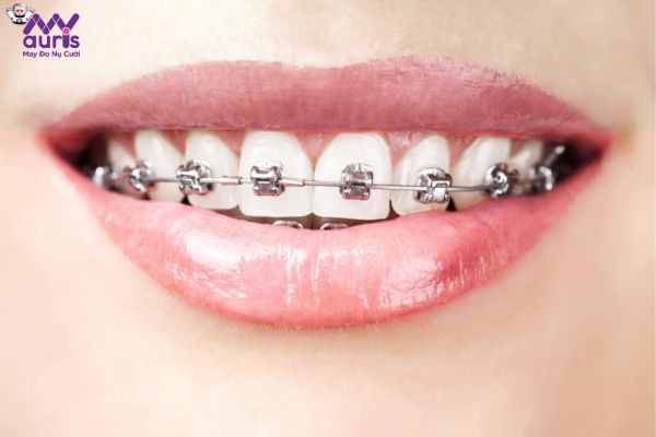 Phương pháp chỉnh nha niềng răng mắc cài kim loại tự buộc là gì?