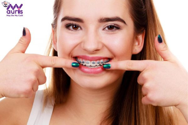 So sánh các tiêu chí giữa niềng răng mắc cài thường và niềng răng mắc cài kim loại tự khóa