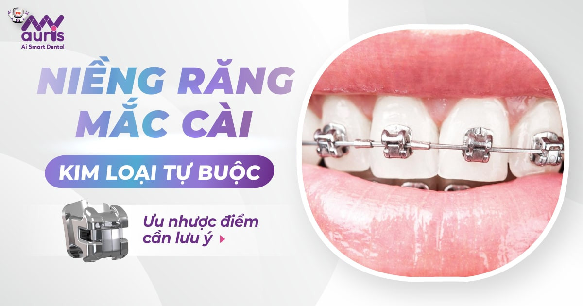 Niềng răng mắc cài kim loại tự buộc (6 ưu điểm chính)