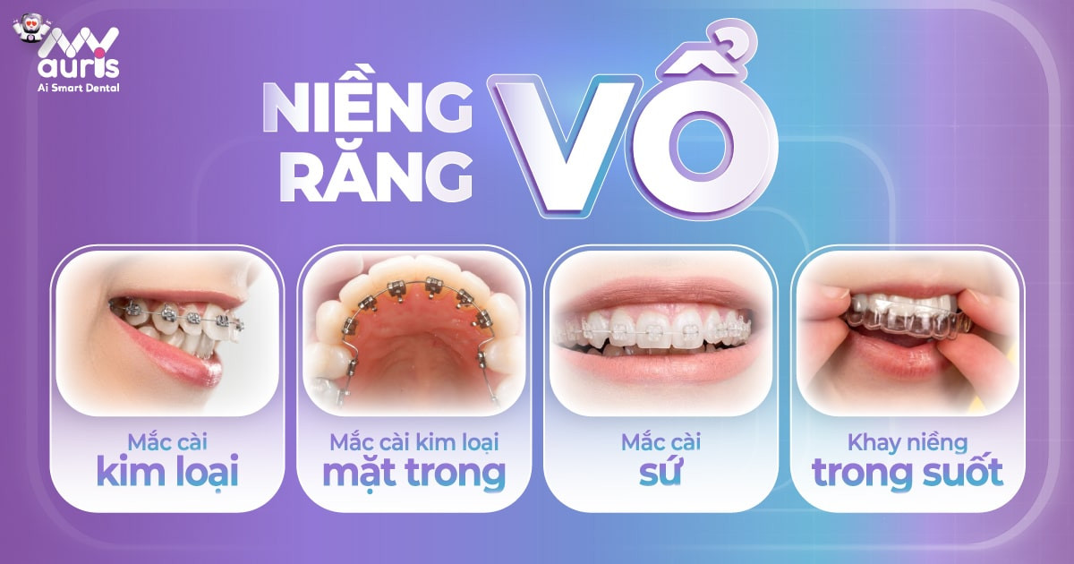 Niềng răng vổ - 4 phương pháp chỉnh nha an toàn