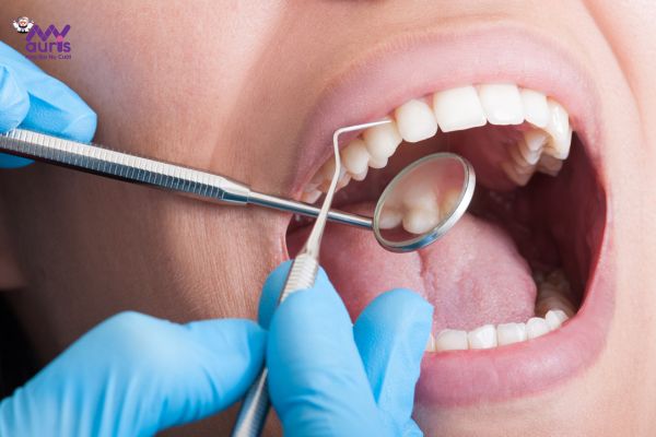 quy trình dán răng sứ veneer 