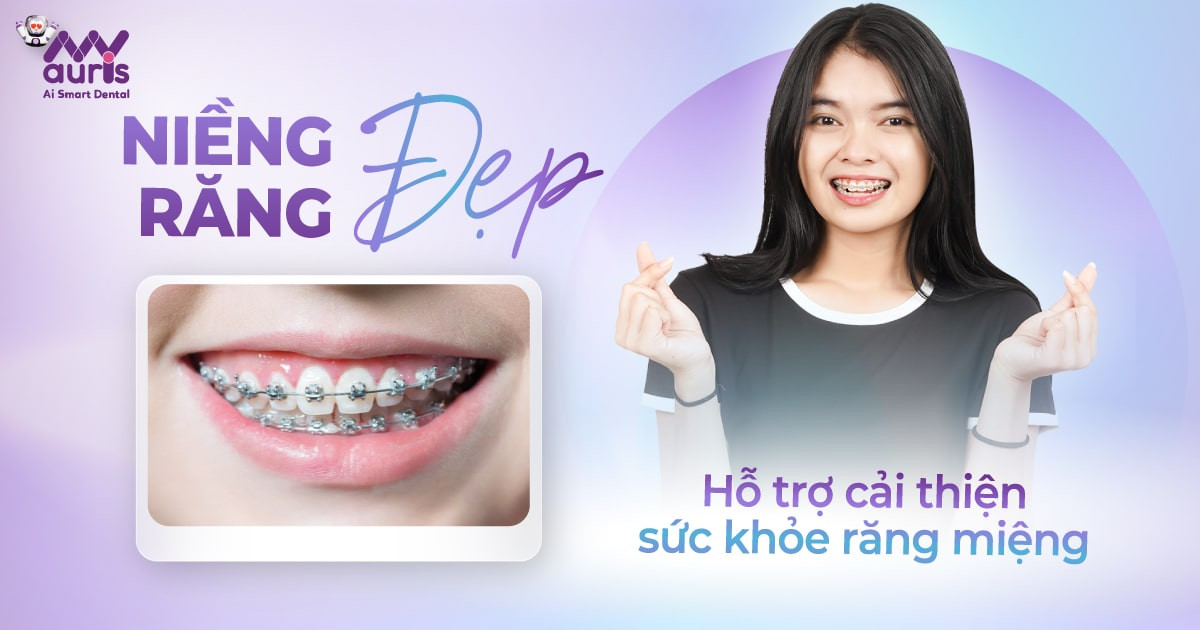 [Giải đáp] Niềng răng đẹp thường mất thời gian bao lâu?