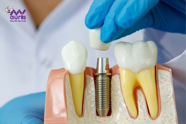 trồng răng bằng phương pháp implant 