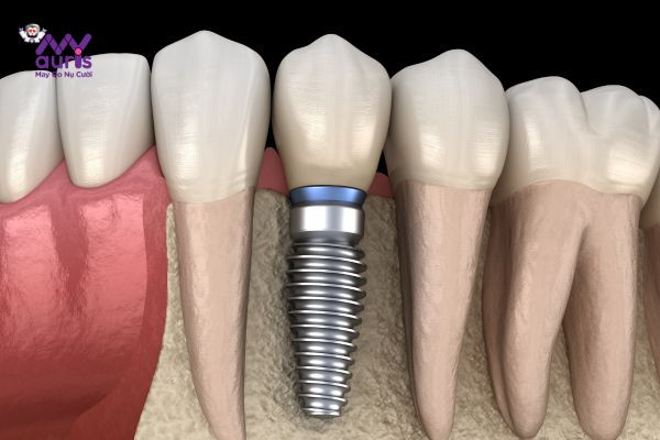 trồng răng bằng phương pháp implant 