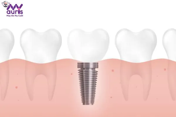 Giải đáp trồng răng Implant có đau không?